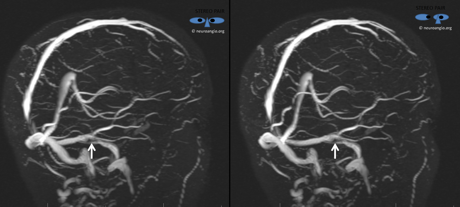 Pulsatile Tinnitus Carotid Artery Dissection